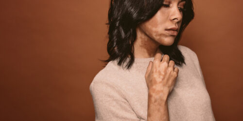 10 Home Remedies to Manage Vitiligo