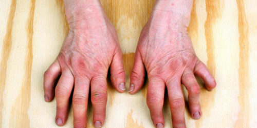 Do you have psoriatic arthritis symptoms