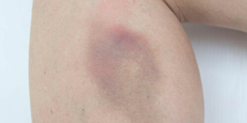 Easy bruising – Causes and treatments