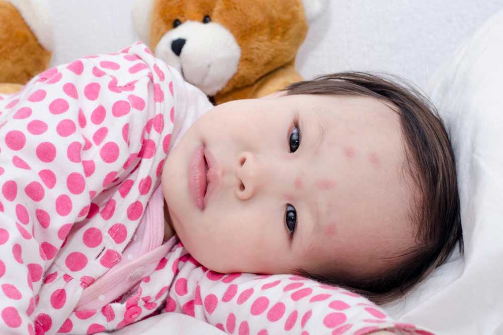 Here’s How to Identify Common Insect Bites