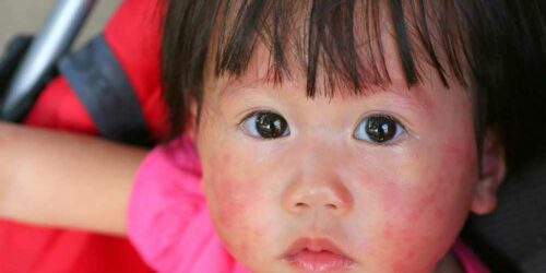 Skin Rashes – Common Types and Causes