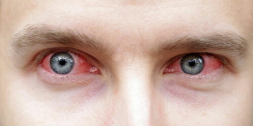 Tips to control the symptoms of Sjogren’s syndrome effectively