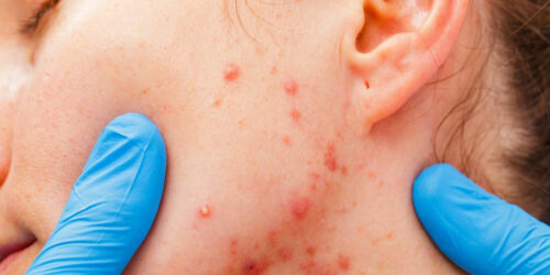 What you need to know about the types and stages of myeloma