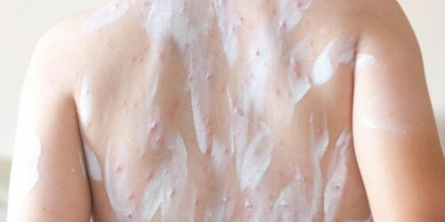 Atopic Dermatitis – Treatment Options That Can Be Tried at Home