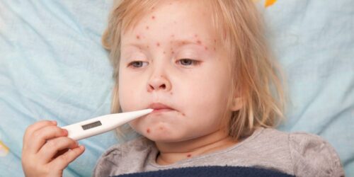 Causes, Symptoms, and Treatment of Measles