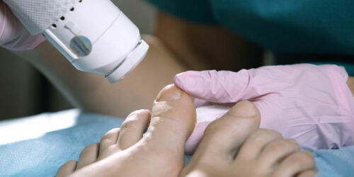 Essential Facts about Nail Fungus Cure