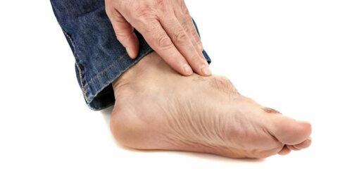 Gout – Causes, Symptoms, Treatment, and Diet Plans