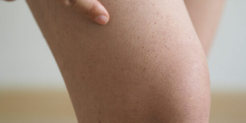 Popular treatment options for hemophilia