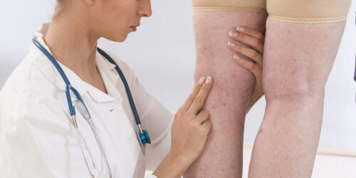 Standard Methods Used for the Treatment of Deep Vein Thrombosis