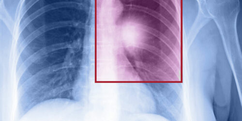 Symptoms and Treatment of Metastatic Lung Cancer