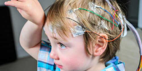 Seizures – Symptoms and Treatment