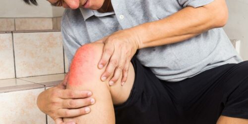 Signs and Symptoms of Gout