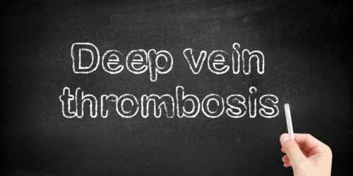 Simple tips to manage and ensure deep vein thrombosis prevention