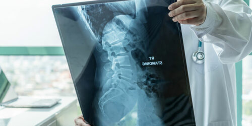 Spinal muscular atrophy – Types and symptoms