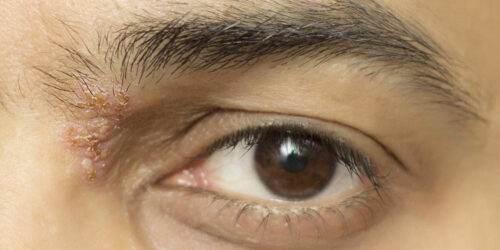 5 Treatments for Shingles Nerve Pain