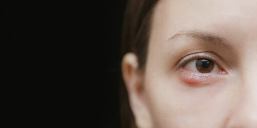 3 Ways to Get Rid of a Chalazion